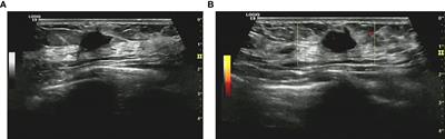 Contrast-enhanced ultrasound of granular cell tumor in breast: A case report with review of the literature